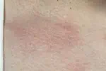ストレス蕁麻疹ってどんな見た目？実際の写真で見る症状と私の体験