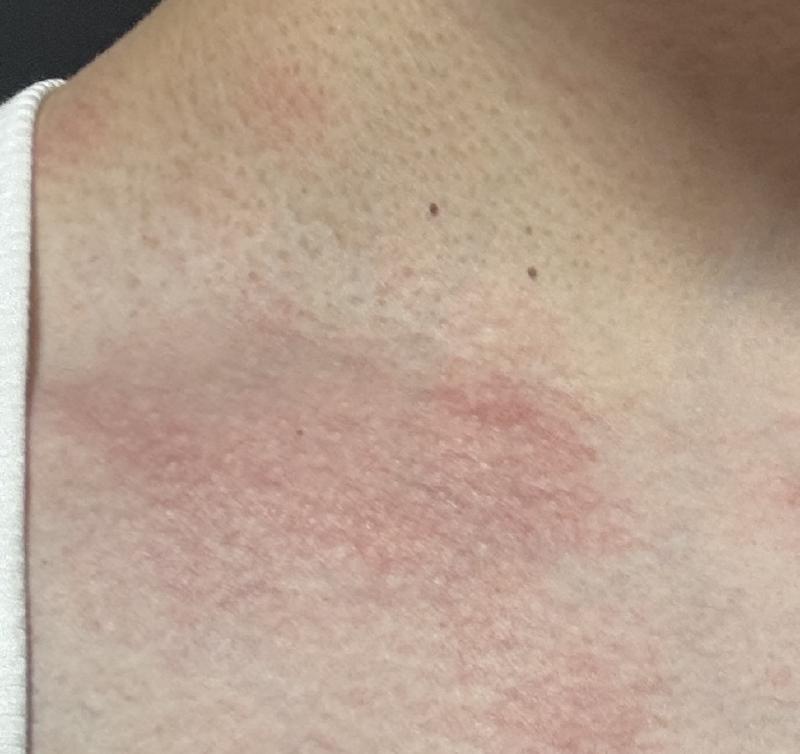 Featured image of post ストレス蕁麻疹ってどんな見た目？実際の写真で見る症状と私の体験