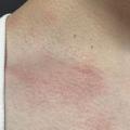 ストレス蕁麻疹ってどんな見た目？実際の写真で見る症状と私の体験